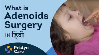 What is Adenoids Surgery in hindi [upl. by Ingra]