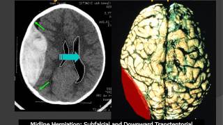 MedPix® Traumatic Brain Injury  Epidural Hematoma RadiologicPathologic Correlation [upl. by Pyne]