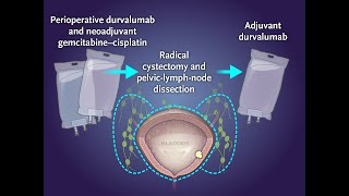 Perioperative Durvalumab in Bladder Cancer  NEJM [upl. by Ehcadroj]