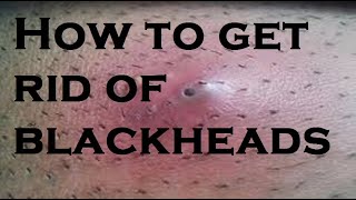 get rid of blackheads [upl. by Nalro]