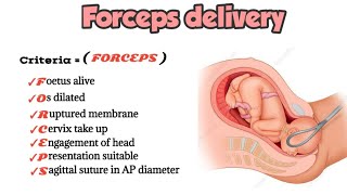 Forceps delivery indications criteria contraindications  medicalmnemonics786 [upl. by Ahseeyt510]