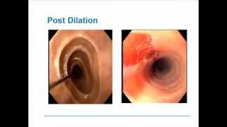 Eosinophilic Esophagitis [upl. by Selassie]