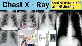 Chest X Ray  X Ray  X Ray Reading  Pneumonia  Lungs Effusion  X Ray Technician  Doctor  bhms [upl. by Oibesue]