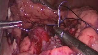 Laparoscopic Cysto Gastrostomy for Pseudocyst Pancreas [upl. by Lotson]