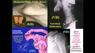 Knee Disarticulation [upl. by Raskin]