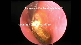 ear wax removal extractionseveral cases simple cerumen clearance [upl. by Kurth]