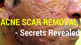 How to treat acne scars Dermatology Secrets revealed [upl. by Ahsen]