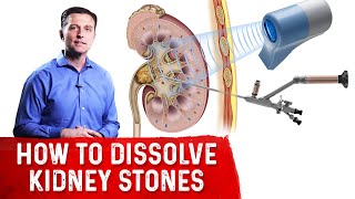 How To Dissolve Kidney Stones Explained By DrBerg [upl. by Gitel]