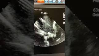 Intracardiac echo of left atrium during afib ablation [upl. by Neztnaj]