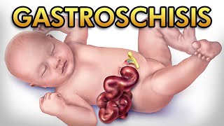 Gastroschisis Pathophysiology Diagnosis Treatment and Comparison against Omphalocele [upl. by Uis]