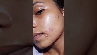 How did I fix my face minimalist facepeel acneproneskin skincare viralvideo [upl. by Didi]