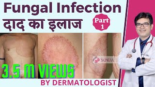 Fungal Infection Treatment In Hindi  फ़ंगल इन्फ़ेक्शन का इलाज हिंदी में  Dermatologist  Dr Sunil [upl. by Nylannej]