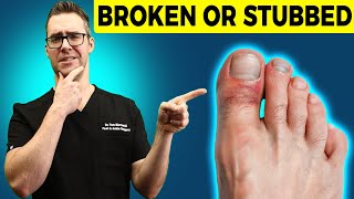 Stubbed Toe or Broken Toe Symptoms Pain Relief amp Treatment [upl. by Nonnel]