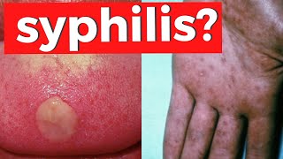 SYPHILIS  Everything You Need To Know about Treponema Pallidum [upl. by Malvina]