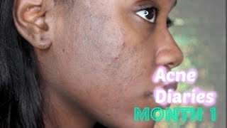 Skin  Acne Diaries Month 1 Doxycycline  Neutrogena Rapid Clear  Retin A  Shanese Danae [upl. by Nuawad836]