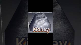 Small Kidney  cortical Thinning  Renal parenchymal Disease on Ultrasound [upl. by Lokkin]