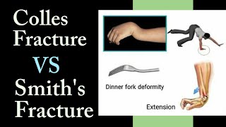 Colles Fracture VS Smiths Fracture II Timesphysio [upl. by Marler]