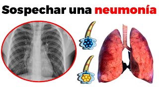 Síntomas de NEUMONÍA cómo se diagnostica y tratamiento [upl. by Charleton574]