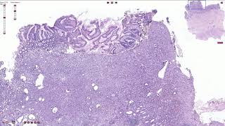 Poorly Cohesive Adenocarcinoma Stomach  Histopathology [upl. by Polish]