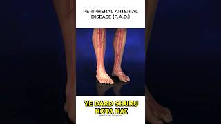 Claudication In Legs Symptoms  Claudication  Leg Pain  Dr Gaurav Gangwani [upl. by Galloway213]