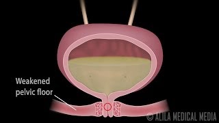 Stress Urinary Incontinence in Women Animation [upl. by Yttisahc]