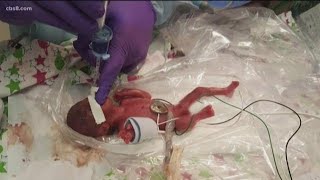 World’s smallest surviving baby born in San Diego [upl. by Itteb479]