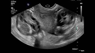 Bilateral salpingitis ultrasound [upl. by Nnyleimaj]