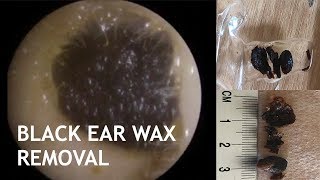 BLACK EAR WAX REMOVAL  437 [upl. by Ylrebme557]