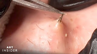 How Ingrown Hairs Are Removed  Art Insider [upl. by Zandt]