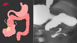 Child with Abdominal Distention and Vomiting  Case Report [upl. by Walther]