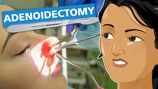 Adenoidectomy [upl. by Arlinda]