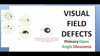 Ophthalmology 236 c Visual Field Defects POAG Primary Open Angle Glaucoma Treatment Laser Surgery [upl. by Wrigley260]