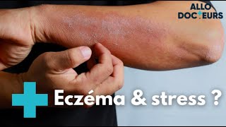 Eczéma  quelles solutions   Allo Docteurs [upl. by Tila]