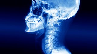 A Man Swallowed Wireless Earbud This Is What Happened To His Esophagus [upl. by Epuladaug]