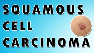 Squamous Cell Carcinoma [upl. by Aeslehs]