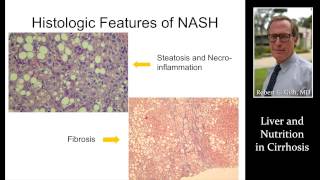 LIVER amp NUTRITION IN CIRRHOSIS by Dr Robert Gish [upl. by Lennor730]