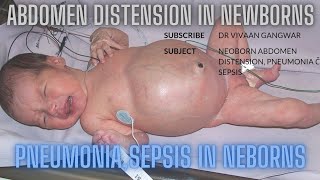 Abdominal Distension In Neonates  Pneumonia In Neonates  Sepsis In Newborn  Neonates In NICU [upl. by Illib873]