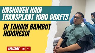 Transplantasi Rambut 1000 Grafts Emang Bisa [upl. by Salisbury]