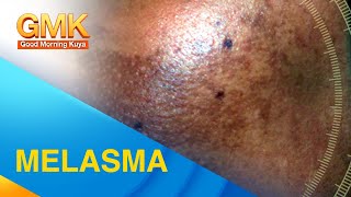 MELASMA Cause and Treatment Explained by Dermatologist [upl. by Madelon]