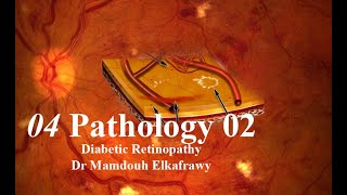 04 Retinal Pathology 02 Elkafrawy pathology باثولوجي الكفراوي Diabetic Retinopathy [upl. by Olaf]