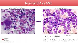 Acute Myeloid Leukemia  Diagnosis and Treatment in 2020 [upl. by Mackenzie]