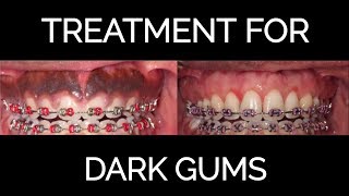 Gum Bleaching Procedure for Black Gums 2018 [upl. by Boniface]