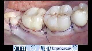 Periodontal surgery Lower right molars [upl. by Finbur]