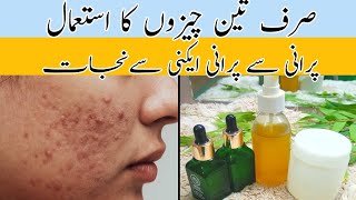 treatment for acne  Remove pimple home remedies [upl. by Hanikehs469]