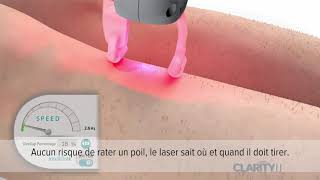 Epilation laser  Alexandrite et Yag [upl. by Yasmin]