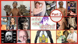 अजीबोगरीब मेडीकल बीमारियां पार्ट २ RareWeirdStrangeMind Boggling DiseasesSyndrome in the Human [upl. by Yrac]