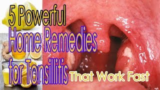 5 Powerful Home Remedies for Tonsillitis That Work Fast [upl. by Evangelin]