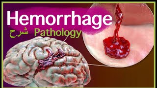 Pathology  Hemorrhage  Blood Hemodynamic disorders شرح باثو [upl. by Colyer]