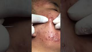 Best Pimple Popping 15 beautiful blackheads sacdepspa [upl. by Dylane]