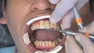 Chairside Live Episode 79 This Anterior CrossBite Patient Wanted Veneers [upl. by Eelyma864]